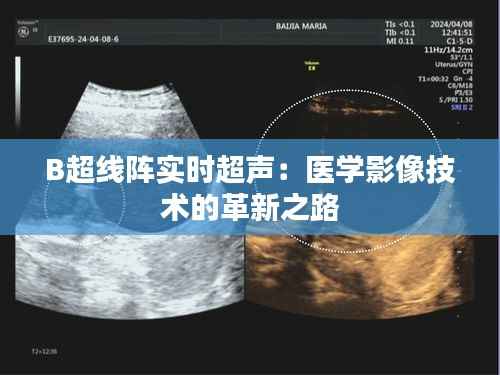 B超线阵实时超声:医学影像技术的革新之路